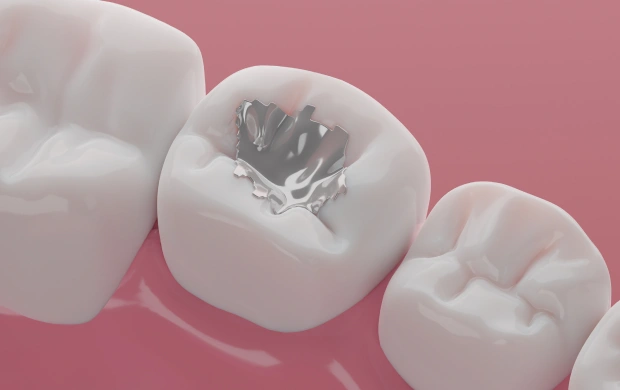 Dental Fillings