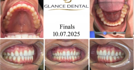 invisalign-after-2