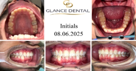 invisalign-before-3