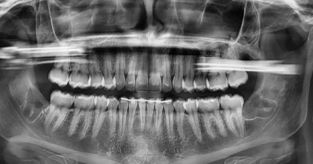 wisdom-teeth-after-2